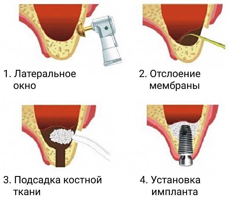 Имплантация зубов в Твери 2