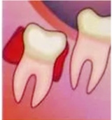 Удаление зубов 7