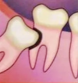 Удаление зубов 1