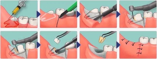 Удаление зубов 9