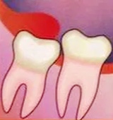 Удаление зубов 3