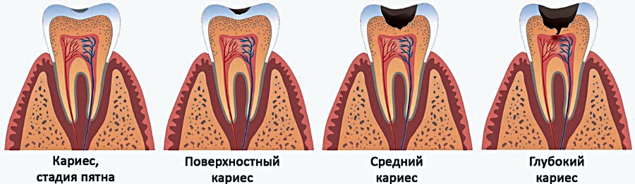 Лечение зубов 2