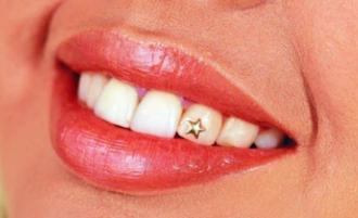 Украшение зубов - привлекательно и доступно 5